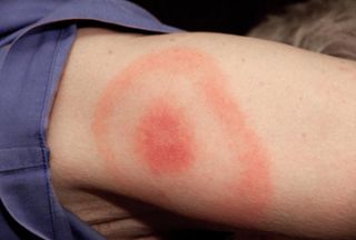 Lyme Prevention Tick Control Peter Benz